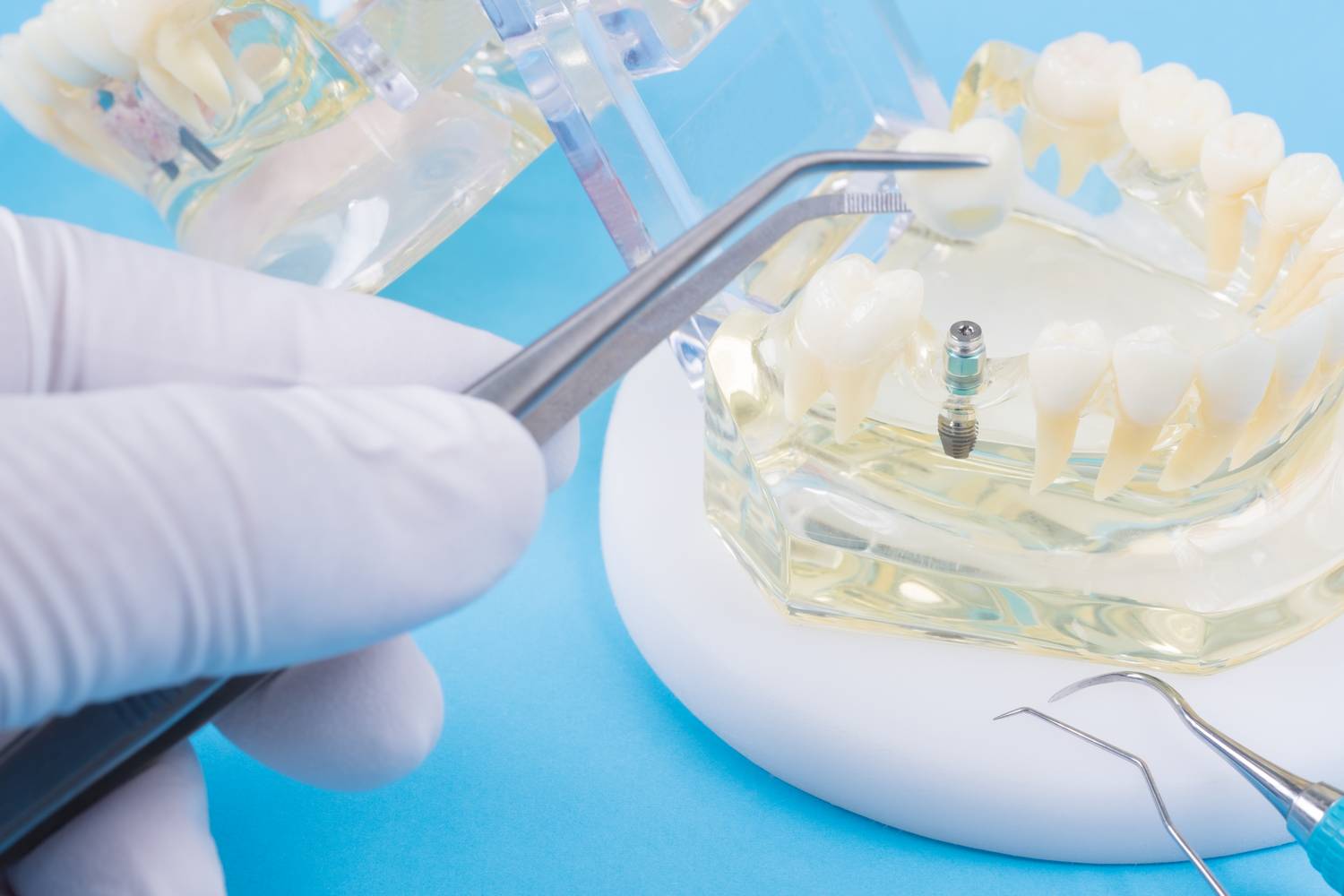 Ile kosztuje implant?